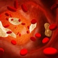 Низкий уровень холестерина может быть связан с худшей выживаемостью больных с раком почек